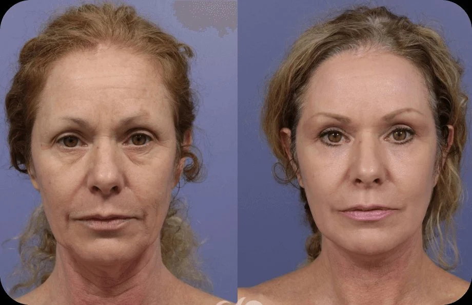 Before and after using Synevra Lift & Lock System
